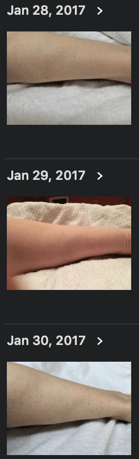 Parapulser - miniZap - Dr Beck Protocol tick bite target Lyme disease remediation photos