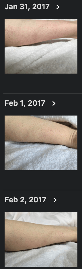 Parapulser - miniZap - Dr Beck Protocol tick bite target Lyme disease remediation photos