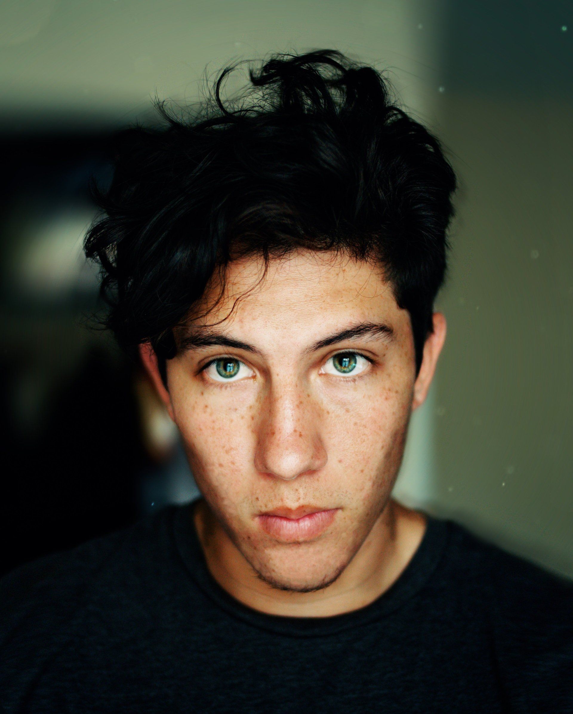 Teenager facing acne