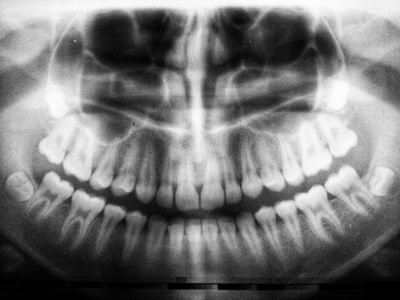 Root Canal Therapy