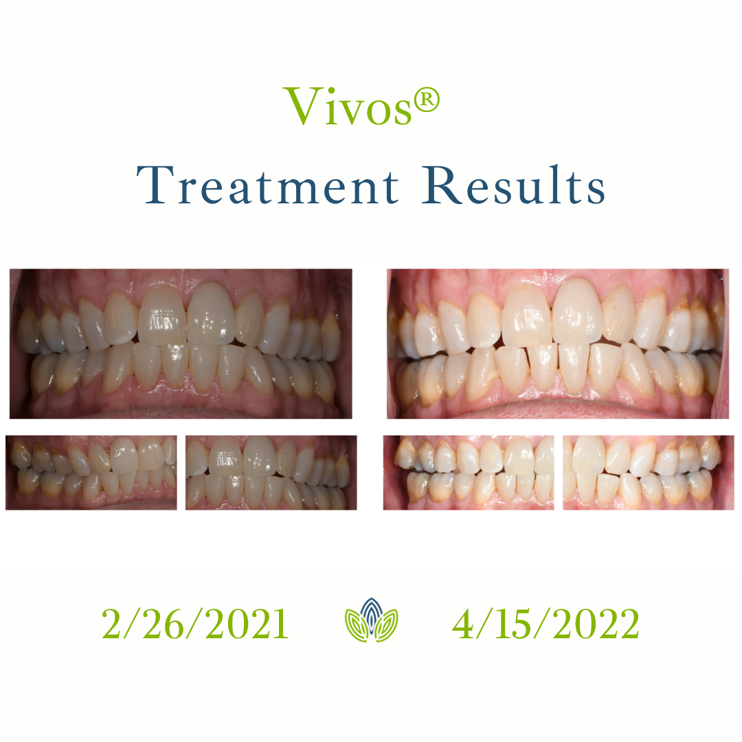 Vivos treatment results showing before-and-after teeth photos dated 2/26/2021 and 4/15/2022