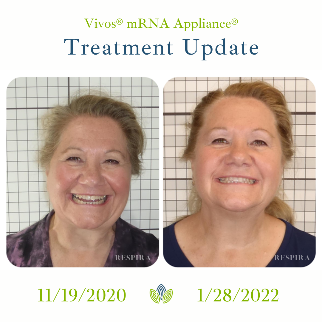 Before-and-after smile photos labeled “Vivos mRNA Appliance Treatment Update,” dated 11/19/2020 and 1/28/2022