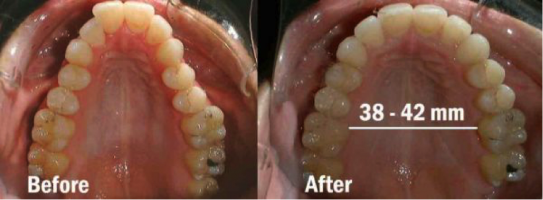 Side-by-side dental arch photos labeled “Before” and “After,” showing a 38–42 mm palate width change