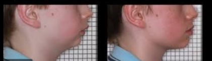 Side-by-side profile photos of a person’s face with a visible red rash on the cheek and jawline.