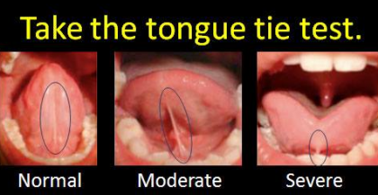 Tongue tie test chart with three mouth photos labeled normal, moderate, and severe.