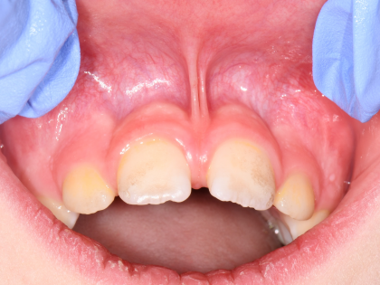 Close-up of upper front teeth with a gap and red gums, held open by gloved hands