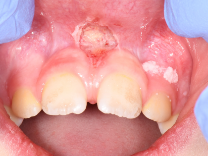Close-up of upper front teeth and gums with a red, inflamed lesion above the teeth.