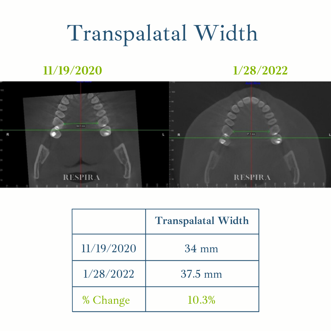 Palatal width comparison chart with two dental X-rays and a table showing 34 mm to 37.5 mm, 10.3% increase