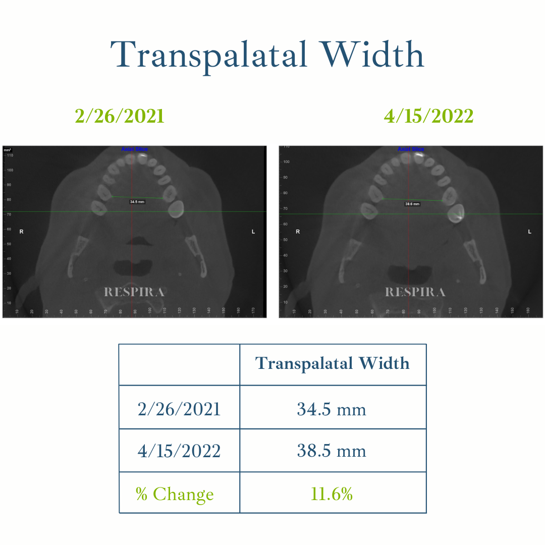 Transpalatal width comparison of two dental scans, 2/26/2021 and 4/15/2022, with 11.6% change shown