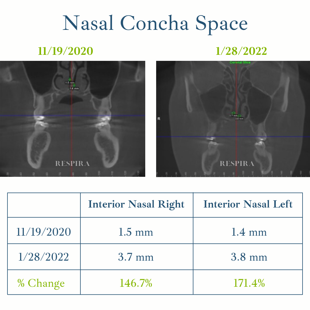 Nasal concha space comparison chart with two CT scans and a table showing measurements before and after.
