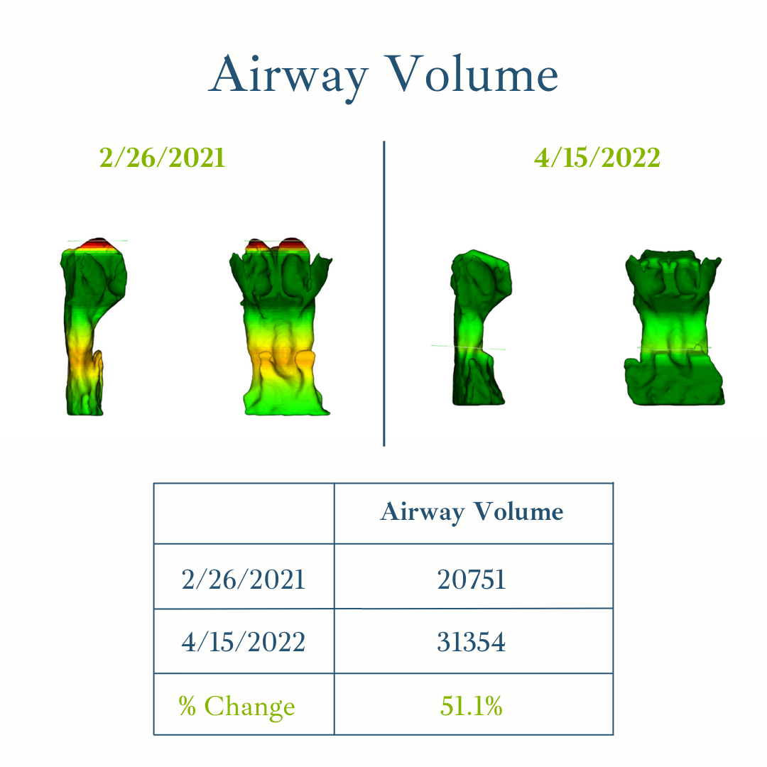 Airway Volume comparison with green/yellow 3D scans and table showing 51.1% increase from 2/26/2021 to 4/15/2022