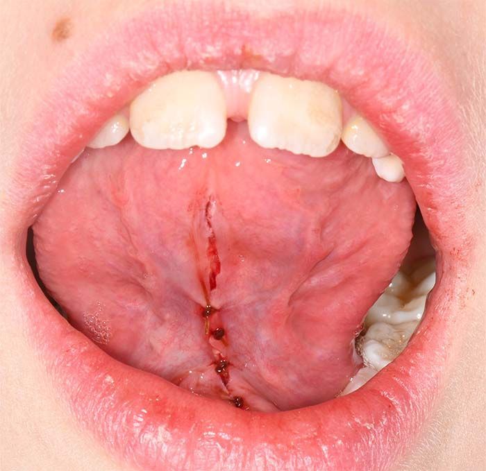 Close-up of open mouth showing tongue with a vertical red cut and small blood droplets