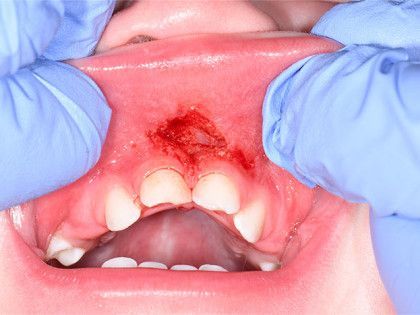 Gloved hands pull back upper lip, exposing a red sore above the front teeth.