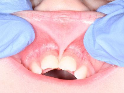Gloved hands lifting a child’s upper lip to show front teeth and gums