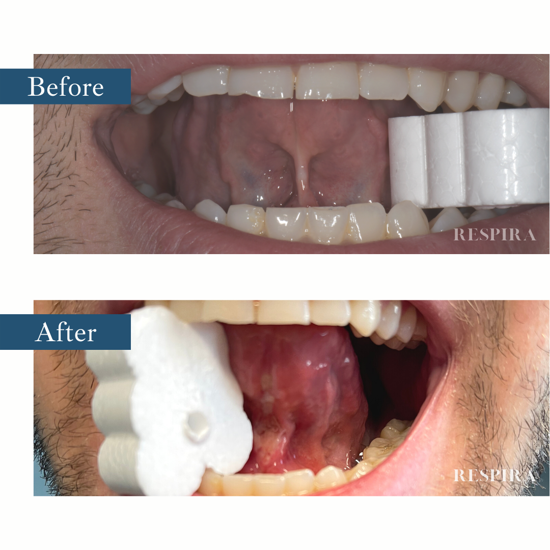 Before-and-after dental photos showing a mouth with a white gauze roll on the right side.
