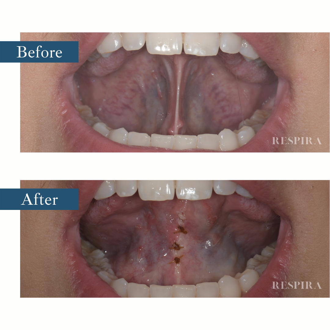 Before-and-after close-up of the inside of a mouth, showing a tongue-tie release with sutures.