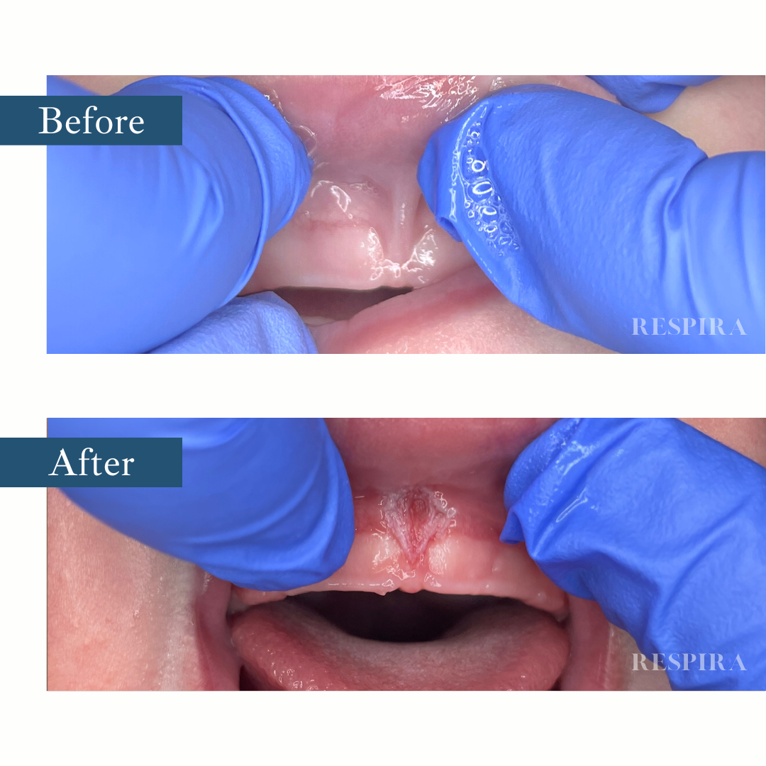 Before and after close-up of a mouth examination with gloved fingers, showing a small opening after treatment.