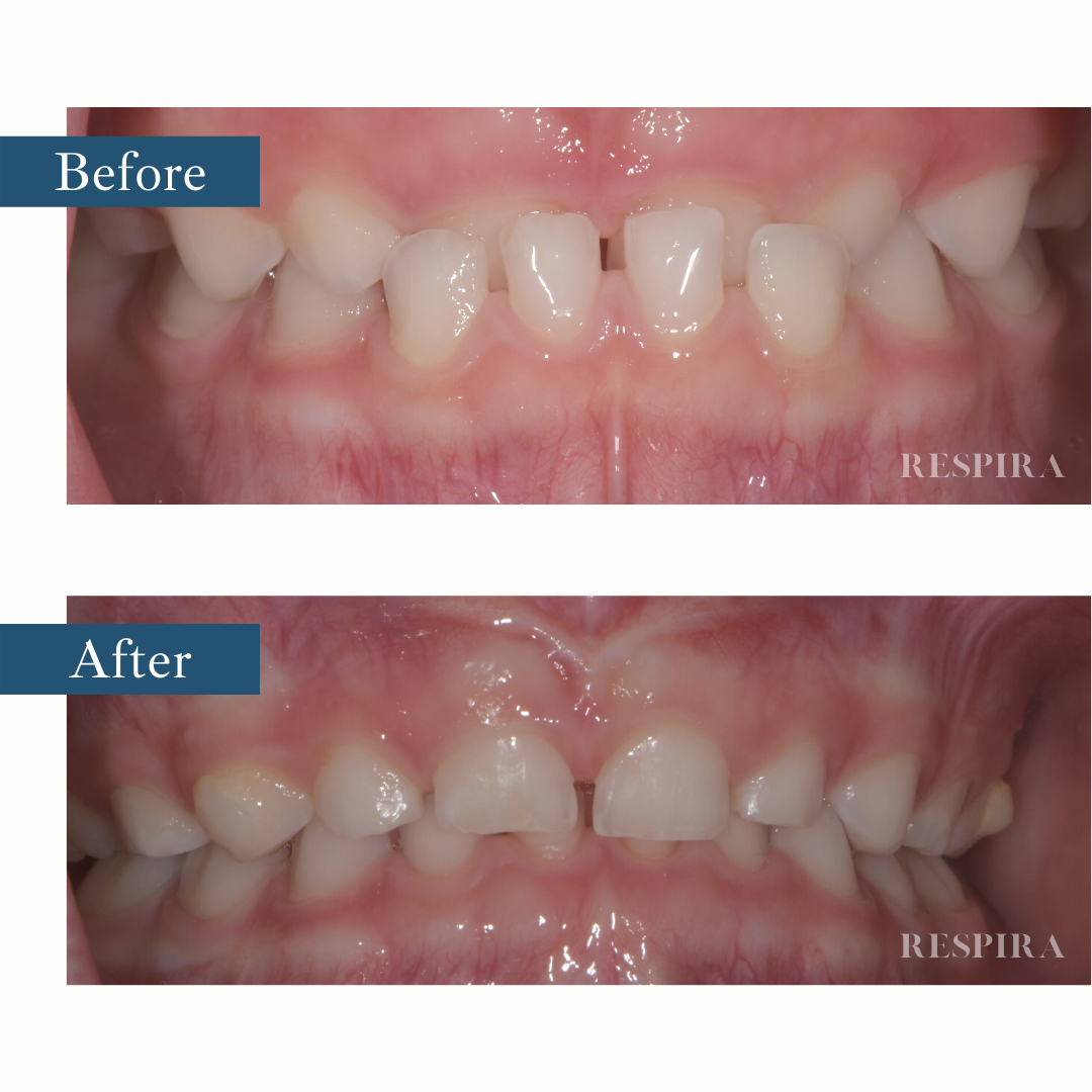 Side-by-side close-up of teeth before and after, showing improved alignment and bite.