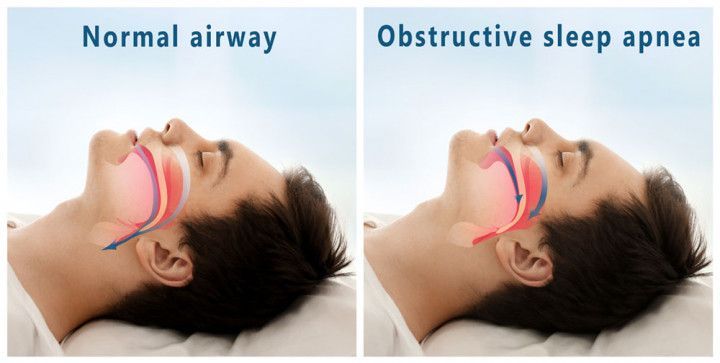  airway diagrams labeled normal airway and obstructive sleep apnea, showing narrowed throat passage in sleep apnea