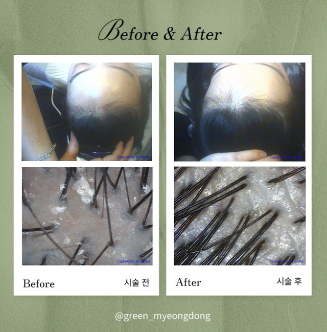 Hair growth result