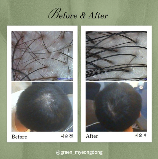 Hair thinning treatment result