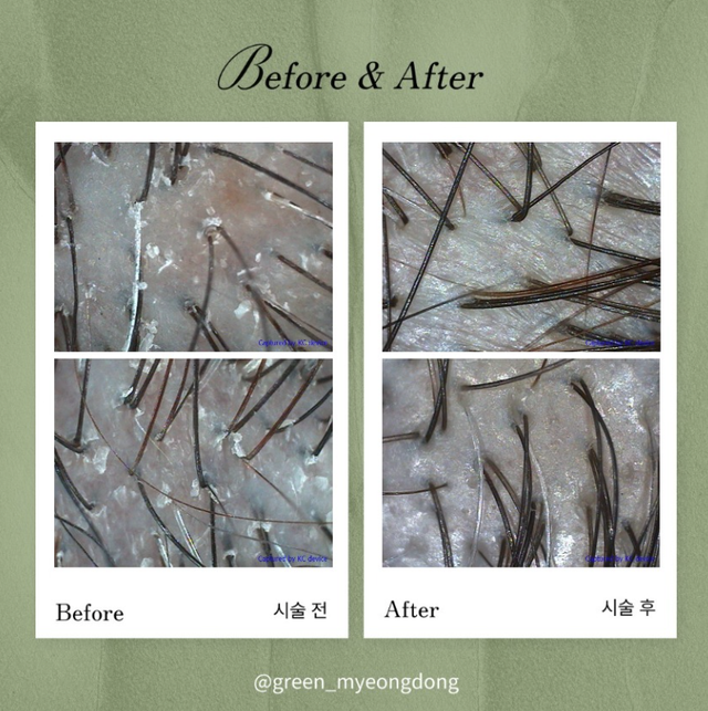 Hair regrowth result