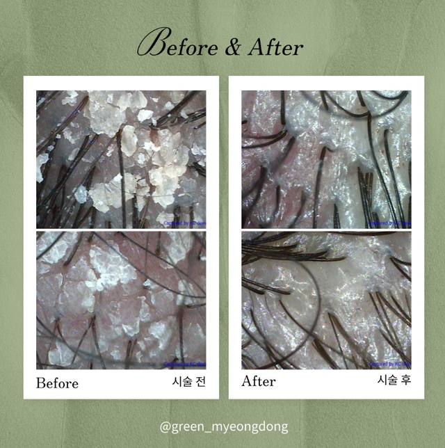 Hair loss treatment result