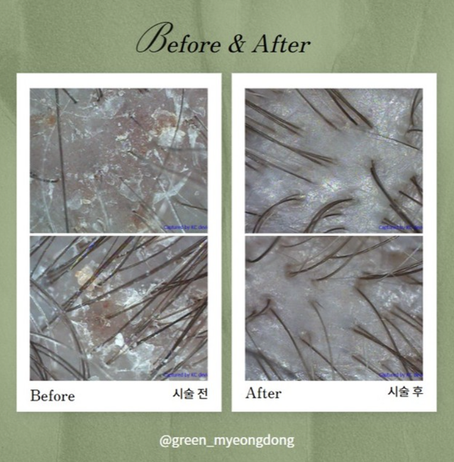 Scalp care result