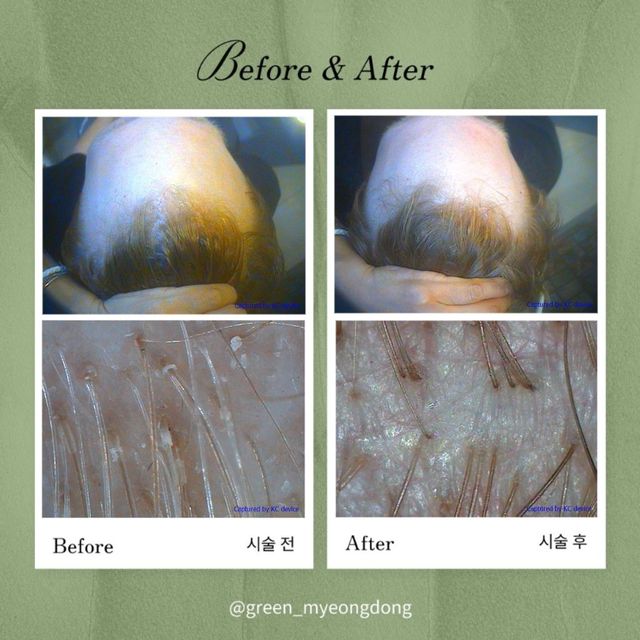 Scalp care result