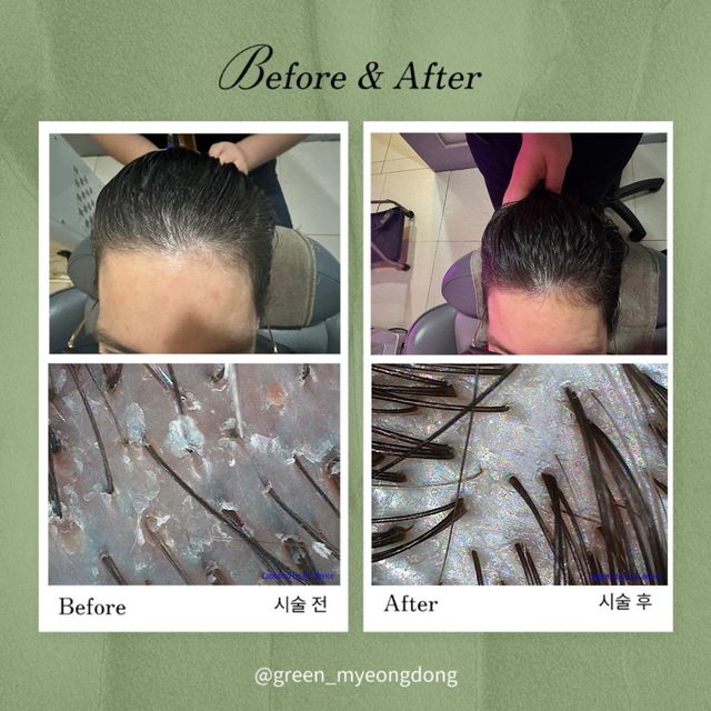 Scalp treatment before and after