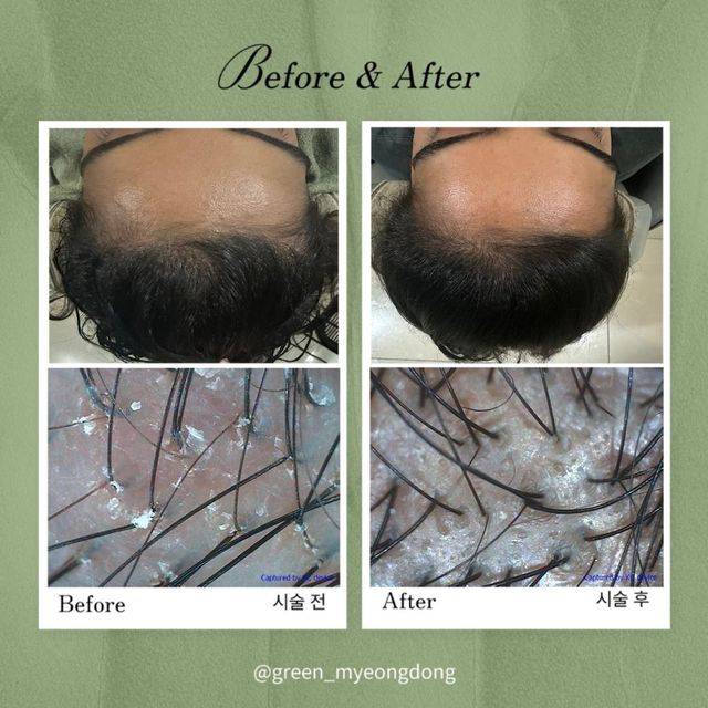 Dandruff scalp treatment result