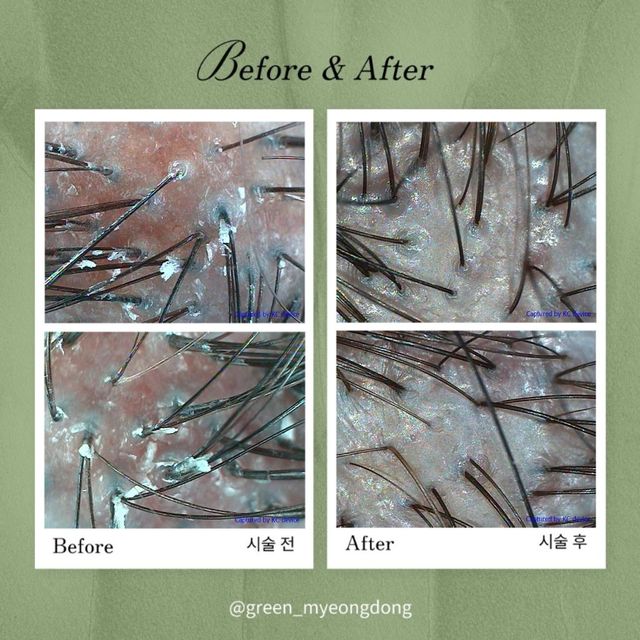 Scalp scaling result