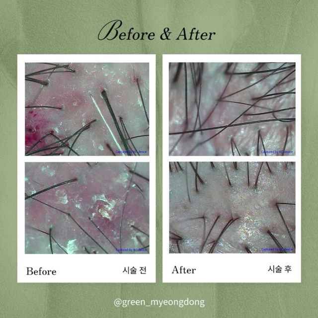 Scalp care before and after