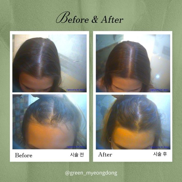 Hairline improvement before and after
