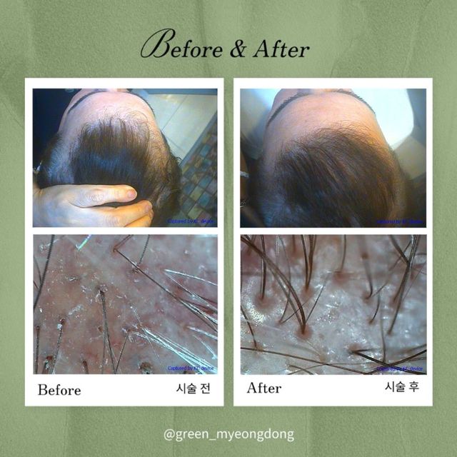 Hair density before and after