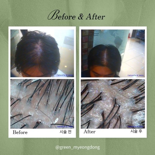 Scalp detox before and after