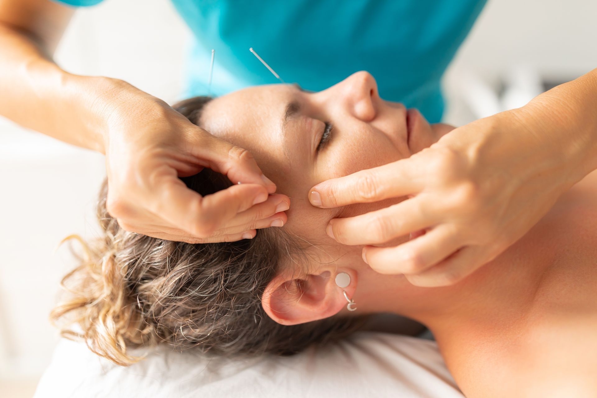 Woman receiving facial acupuncture; needles inserted around her eye and cheek, in a clinical setting.
