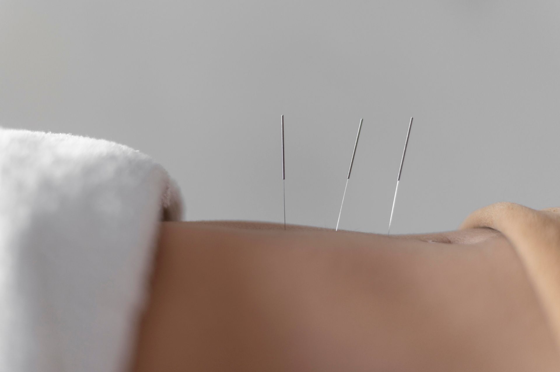 closeup of acupuncture hand