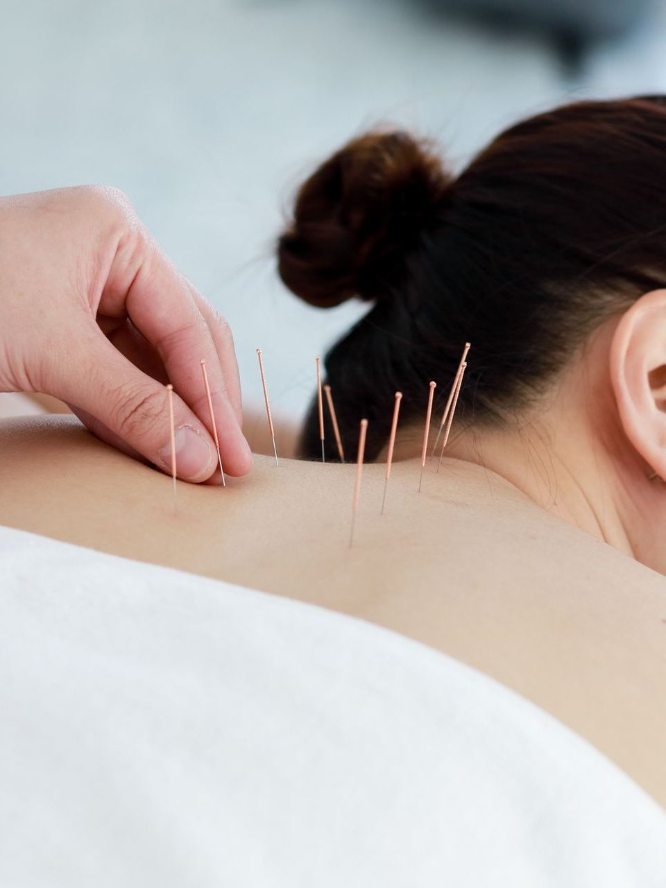 woman getting acupuncture