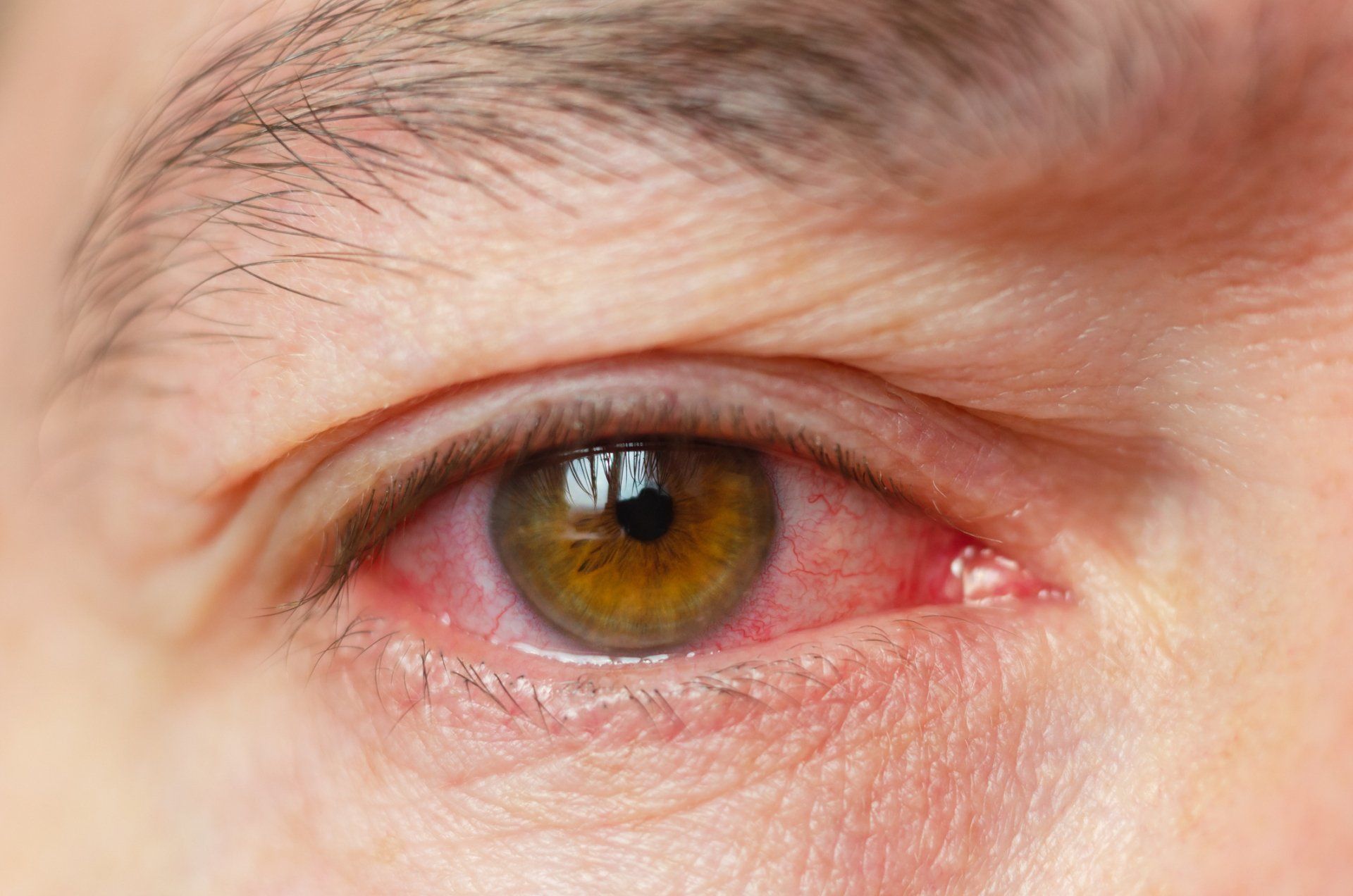 Eye Inflammation - Hanson, KY - Absolute Eye Care, PLC