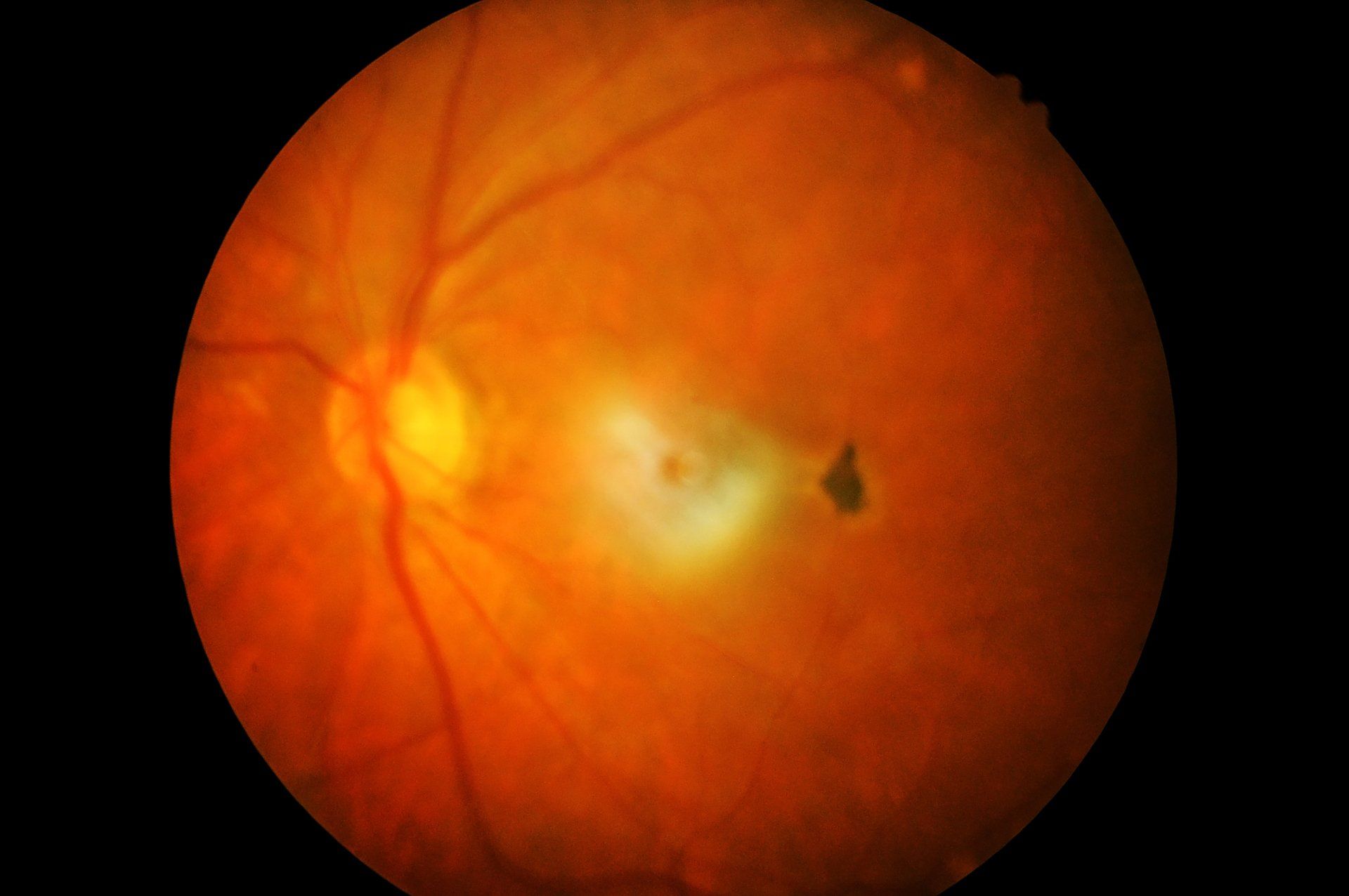 Retinal Detachment Of Diabetes - Hanson, KY - Absolute Eye Care, PLC