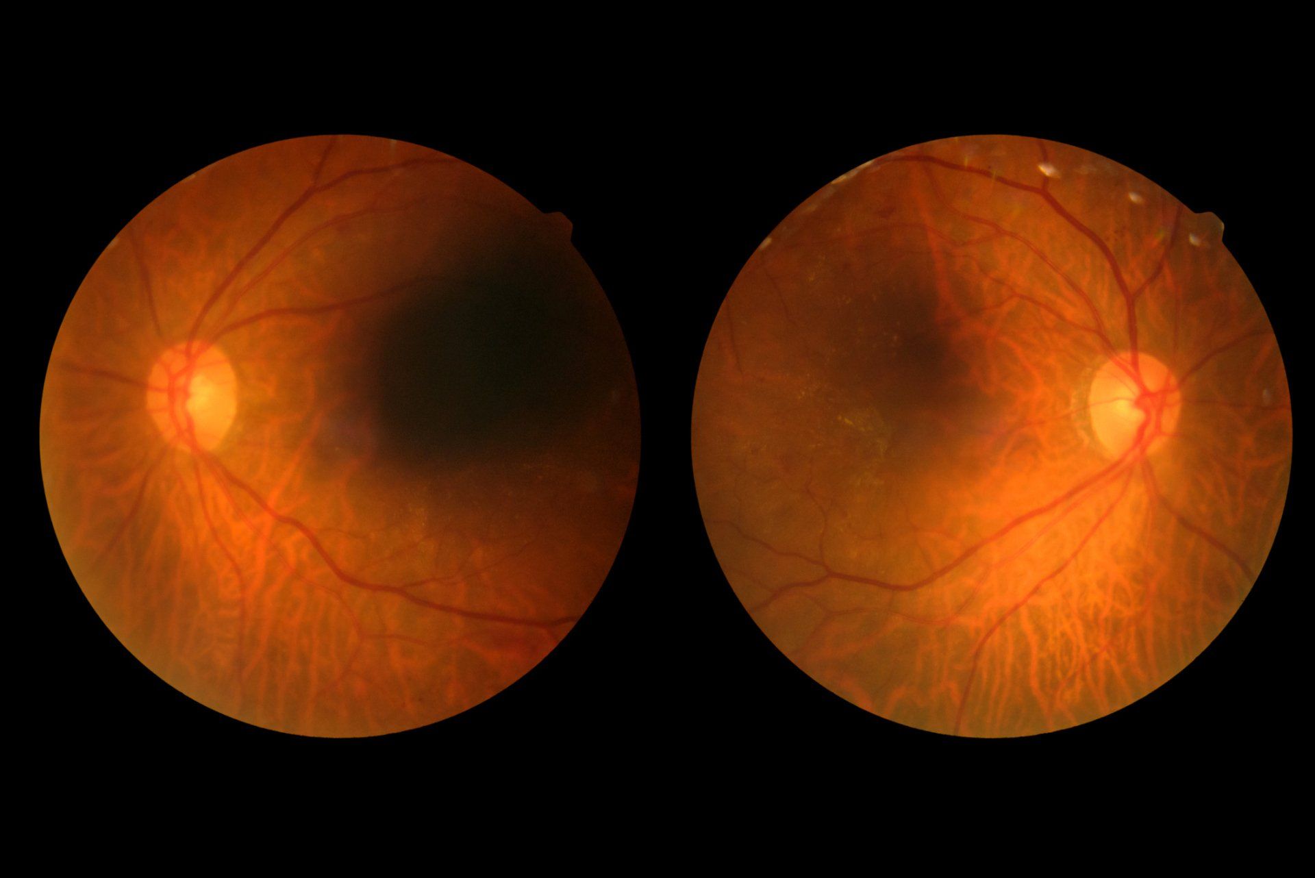 Diabetes Retinopathy - Hanson, KY - Absolute Eye Care, PLC