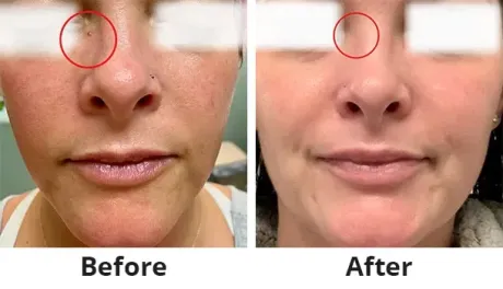 A before and after photo of a woman 's face.