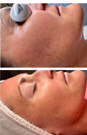 A before and after picture of a woman getting a facial treatment.