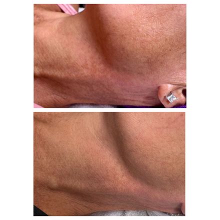 A before and after photo of a woman 's neck and chest.
