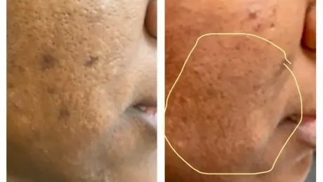 A before and after picture of a person 's face with acne.