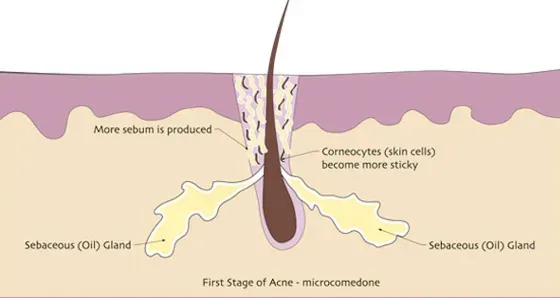 A diagram of the first stage of acne on the skin.