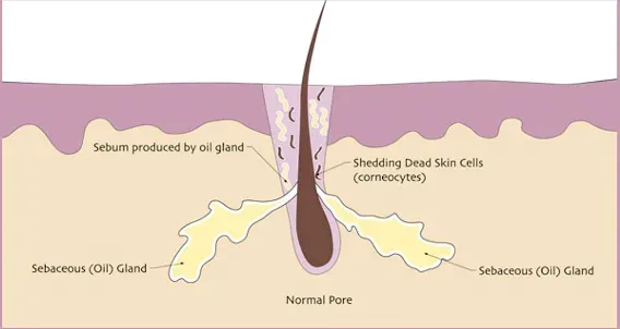 A diagram of a hair growing out of a pimple.