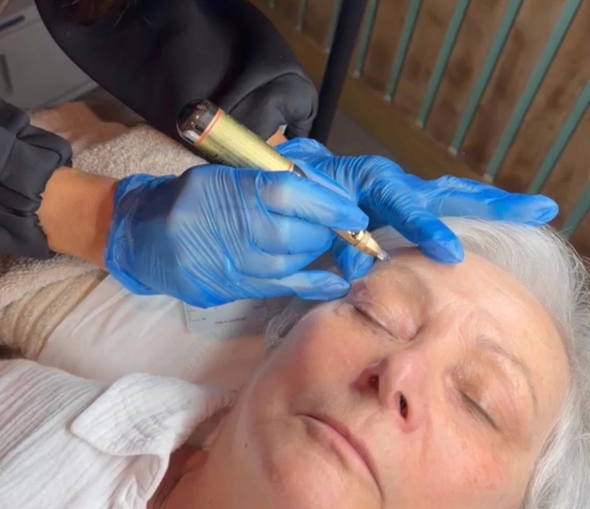 Skin Tag & Age Spot Removal Daventry Cryotherapy