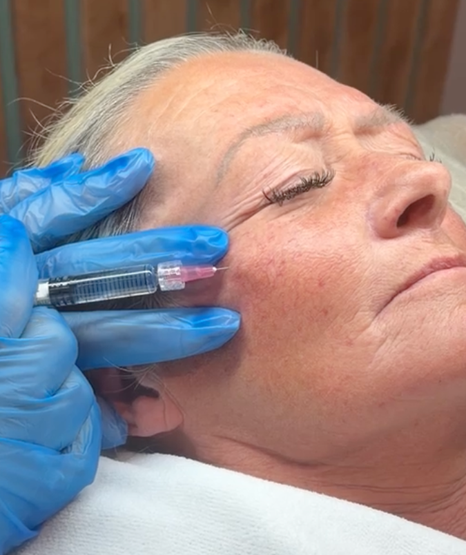 Box of IBSA Profhilo hyaluronic acid skin treatment, used for firmer skin at Claws Nail and Beauty D